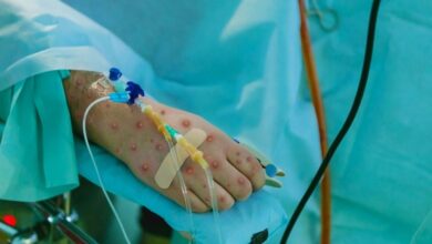 Study: Severe Monkeypox in Hospitalized Patients — United States, August 10–October 10, 2022. Image Credit: Berkay Ataseven / Shutterstock.com