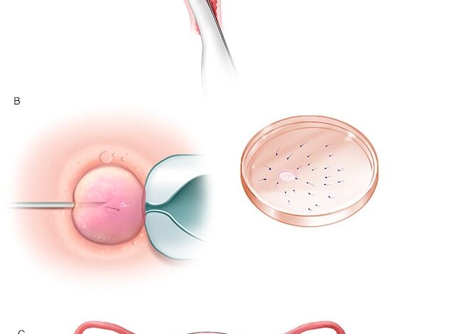 Prozess der In-vitro-Fertilisation