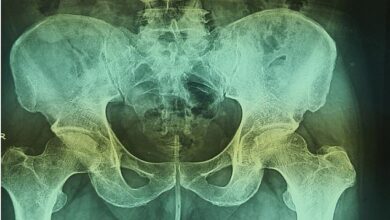 Dieses Röntgenbild zeigt den Draht (Mitte) in der Harnröhre des Mannes und erstreckt sich bis zu seiner Blase
