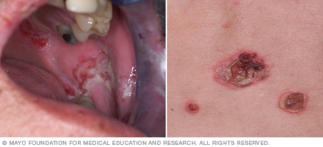Pemphigus vulgaris des Mundes und der Haut