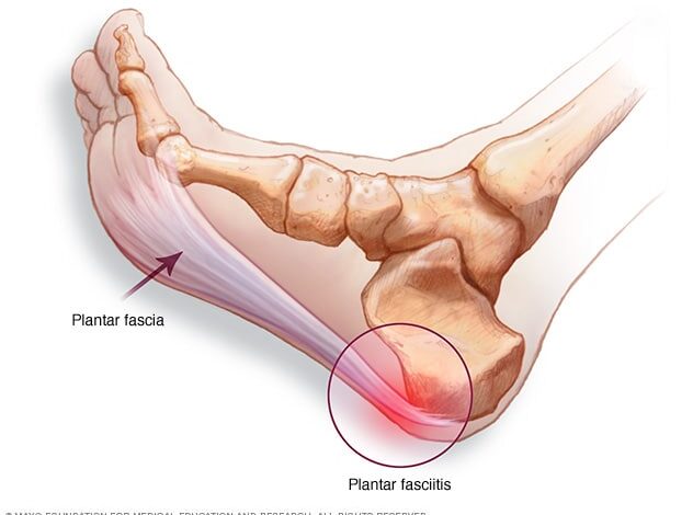 Plantarfaszie und Ort der Fersenschmerzen