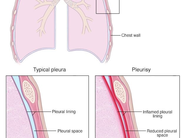 Gesunde Pleuraauskleidung und Pleuritis