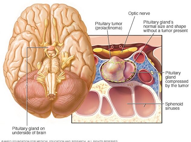 Prolaktinom in der Hypophyse