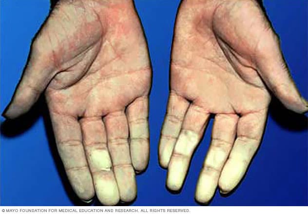 Von der Raynaud-Krankheit betroffene Hände