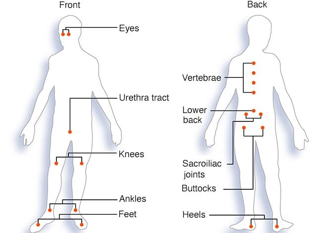 Häufige Entzündungsherde bei reaktiver Arthritis