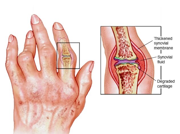Entzündung der rheumatoiden Arthritis
