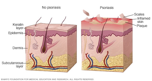 Wie Psoriasis entsteht