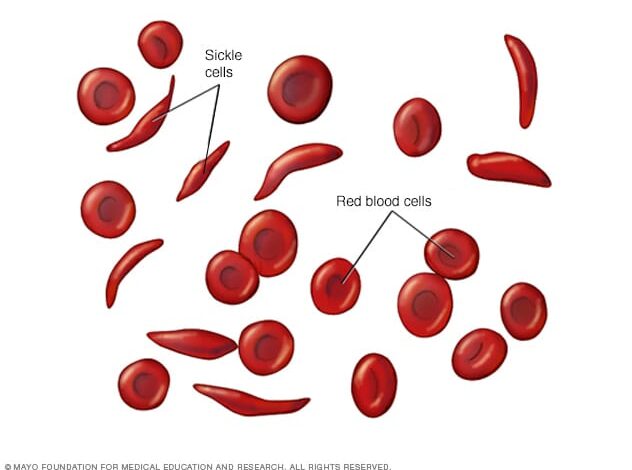 Rote Blutkörperchen und Sichelzellen