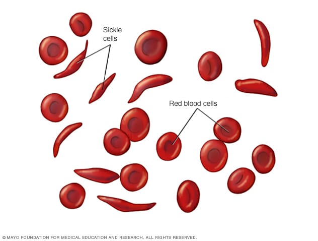 Rote Blutkörperchen und Sichelzellen