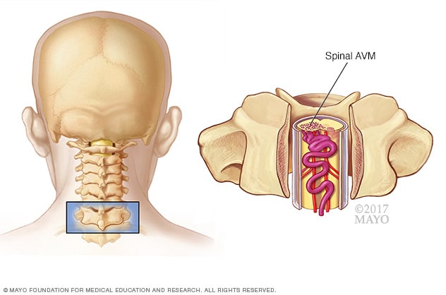 Spinale arteriovenöse Malformation (AVM)