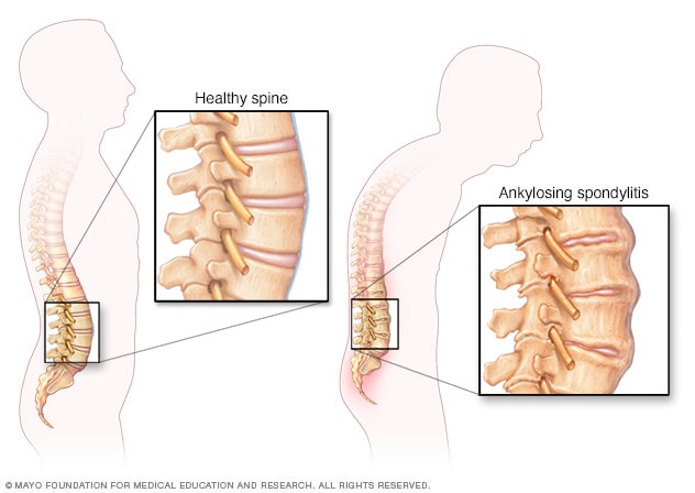 Wirbelsäulenveränderungen bei ankylosierender Spondylitis