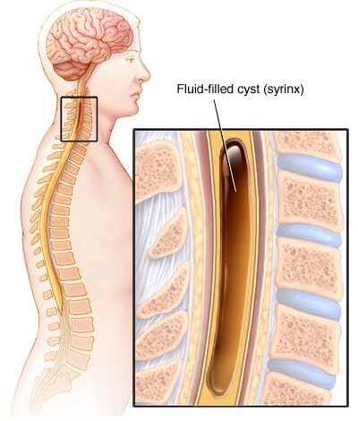Syringomyelie