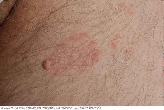 Tinea cruris