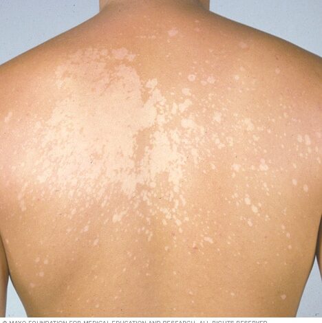 Tinea versicolor