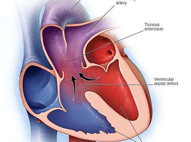 Truncus arteriosus