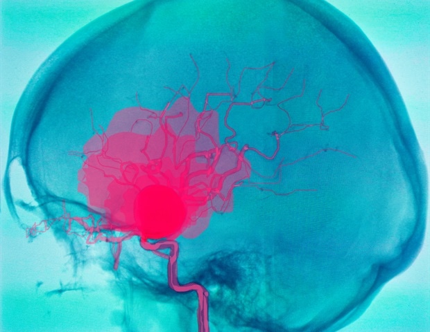 Forscher entwickeln ein mathematisches Modell zur Vorhersage des Aneurysma-Rupturrisikos