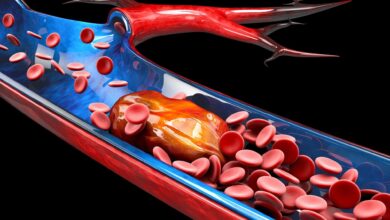 Study: Subtype-specific plasma signatures of platelet-related protein releasate in acute pulmonary embolism. Image Credit: Victor Josan/Shutterstock