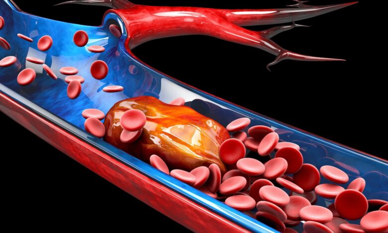 Study: Subtype-specific plasma signatures of platelet-related protein releasate in acute pulmonary embolism. Image Credit: Victor Josan/Shutterstock