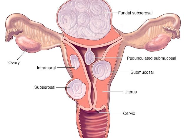 Verschiedene Arten von Uterusmyomen und ihre Lage