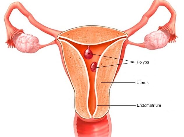 Uteruspolypen
