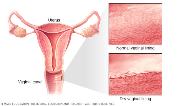 Normale Vaginalschleimhaut vs. trockene Vaginalschleimhaut