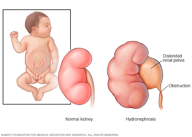Eine normale Niere und eine Niere mit Hydronephrose bei einem Säugling