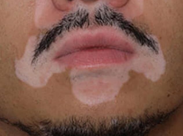 Vitiligo-Flecken im Gesicht
