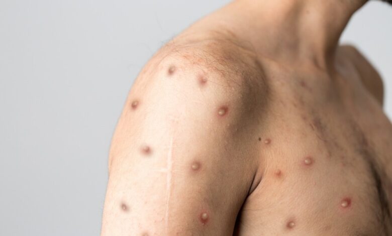 Study: Clinical characteristics of ambulatory and hospitalised patients with monkeypox virus infection: an observational cohort study. Image Credit: Berkay Ataseven/Shutterstock