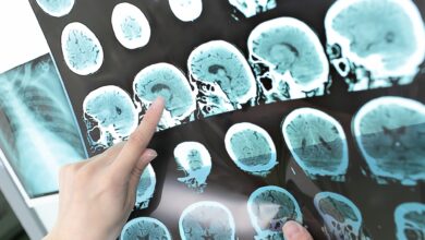 Study: Stroke genetics informs drug discovery and risk prediction across ancestries. Image Credit: sfam_photo/Shutterstock