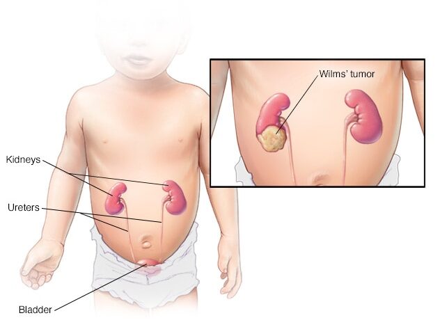 Wilms-Tumor