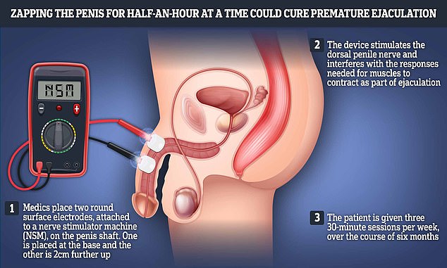 Wissenschaftler glauben, dass sie ein Heilmittel für vorzeitige Ejakulation gefunden haben, das Männern helfen kann, SIEBEN MAL länger im Bett zu bleiben ... aber es beinhaltet das ZAPPEN des Penis mit Strom für jeweils eine halbe Stunde