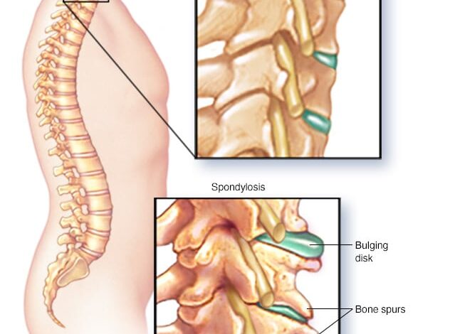Zervikale Spondylose